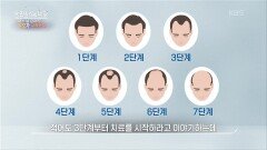 골든타임을 놓치지 마라 – 안드로겐성 탈모 | KBS 260506 방송 