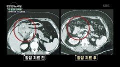 암을 이겨낸 이들에게서 찾는 면역 회복의 열쇠 | KBS 260527 방송 