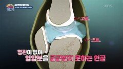 [굿모닝! 건강 브런치] 인공관절의 사용 기한은? 관절 지키는 방법! | KBS 250215 방송 