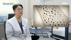 매일 MBP 섭취 후 골강도 변화, MBC 240331 방송