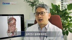 암 발생에 영향을 미칠 수 있는 만성 염증, MBC 240630 방송