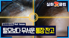 [실화탐사대] 모발 이식은 최소 800만 원? 큰맘 먹고 해야 하는 시술, MBC 260709 방송