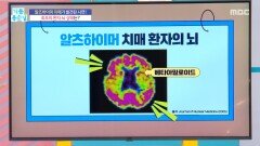 최초 알츠하이머 치매 환자의 뇌 상태는?, MBC 251229 방송