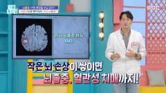 [기분 좋은 날] 역변의 아이콘 처칠! 뇌졸중 한두 번 걸린 게 아니다?, MBC 260622 방송