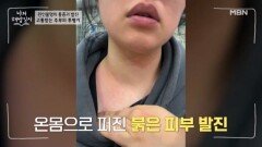 원인불명의 통증과 발진으로 고통받는 주부의 사연 MBN 260304 방송