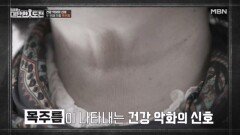 목주름은 혈관 건강 악화의 증거가 될 수 있다 MBN 260315 방송