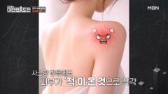 피부 묘기증의 원인 몸 전체의 면역력 문제 MBN 260416 방송