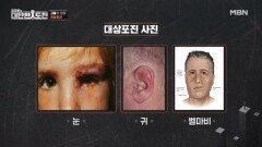 대상포진 바이러스, 뇌도 공격한다 MBN 260416 방송