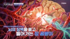 치매, 뇌가 아닌 장에서 시작됐을 수 있다? 뇌를 위협하는 장 곰팡이의 정체는? MBN 260201 방송