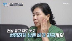 하루 종일 부종에 시달리는 그녀의 사연은? MBN 260113 방송