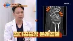 기침했을 뿐인데 뼈가 부러졌다? 명의에게 듣는 '골다공증성 골절' MBN 241211 방송