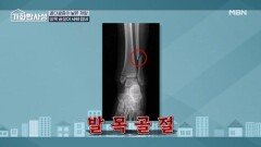 발목 골절로 사망할 수도 있다고? 사람 잡는 미세 골절의 공포 MBN 260120 방송