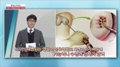 투데이 주치의 - 초중기 퇴행성관절염 치료법 (한마음창원병원 / 김성환 교수)