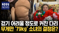 다리 한쪽만 ′79kg′까지 커져 보행 불가능해진 14세 소녀 결국… / KNN