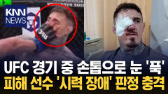 반칙에 눈 찔린 UFC 챔피언 희귀질환 발병에 복귀 ′불투명′ / KNN