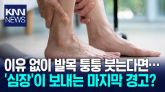 ＂발목 자주 부으면 ′피로′ 아냐＂′이 질환′ 의심하는 중요 신호?/ KNN