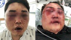 광주 집단 폭행 피해자 상태 얼마나 심각한가 봤더니 ′충격′