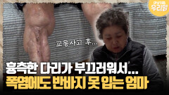 [마냥 이쁜 우리맘 45-2] 흉측한 다리가 부끄러워서... 폭염에도 반바지 못 입는 엄마
