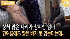 상처 많은 다리가 창피한 엄마 한여름에도 짧은 바지 못 입는다는데.. [다시보는 마냥 이쁜 우리맘 45-2]