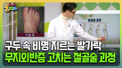 [건강버라이어티 올리브] 구두 속 비명 지르는 발가락 무지외반증 고치는 절골술 과정
