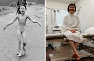 「ナパーム弾少女」のキム・フックさん、爆撃から５０年でやけど治療を終える