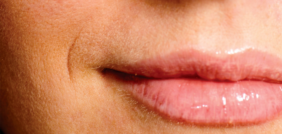 ‘노안의 척도’ 팔자주름 개선하는 필살기