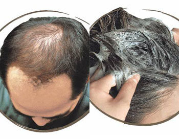 탈모 머리만 잘 감아도