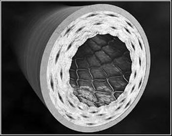 혈관확장술 협심증 치료 약물투여와 별차이 없다