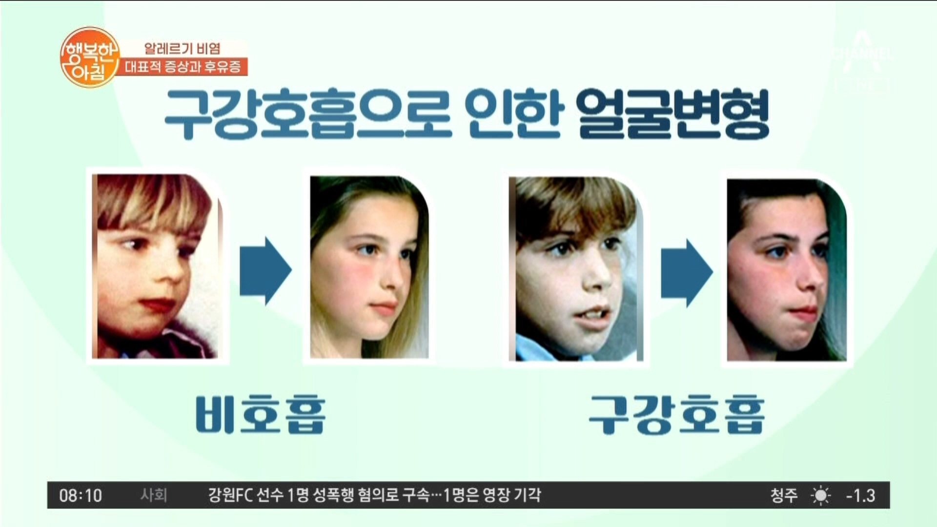 10명 중 2명은 있는 알레르기 비염, 얼굴변형 유발한다? | 보다