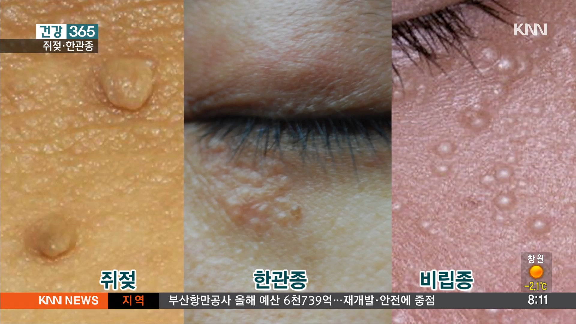 쥐젖, 한관종,비립종 | 보다
