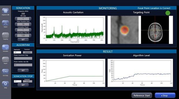 BBB in the brain can be controlled in real time with focused ultrasound / source= Neumous