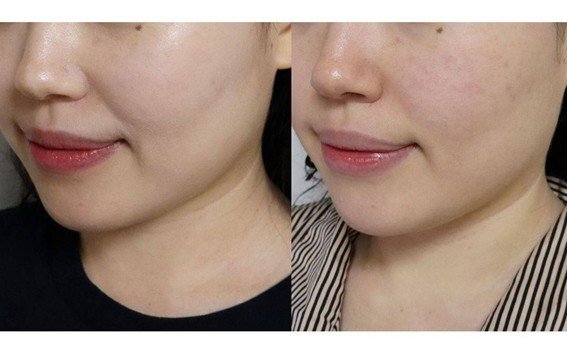 Covering skin tone and blemishes with Medicube Pro Glutacion Glow Cushion (left) and washing with booster vibration cleanser (right). Cushion makeup is removed without residue / source = IT dongA