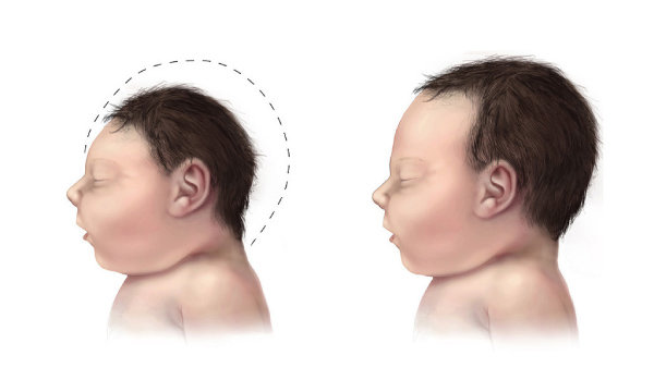 소두증에 걸린 아이(왼쪽)는 머리가 일반 아이에 비해 현저히 작다. [CDC]