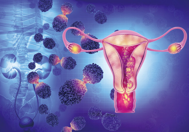 자궁암은 완치가 가능하니 임신 가능성을 쉽게 포기해선 안 된다. [Gettyimage]