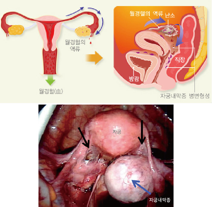 월경혈의 역류에 의해 자궁내막증이 발생할 수 있다(위). 난소에 생긴 혹을 자궁내막종이라고 한다. [질병관리청 국가건강정보포털]