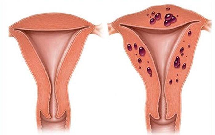자궁선근증은 정상 위치를 벗어나 비정상적으로 존재하는 자궁내막 조직에 의해 자궁의 크기가 커지는 질환을 말한다. [뉴시스]