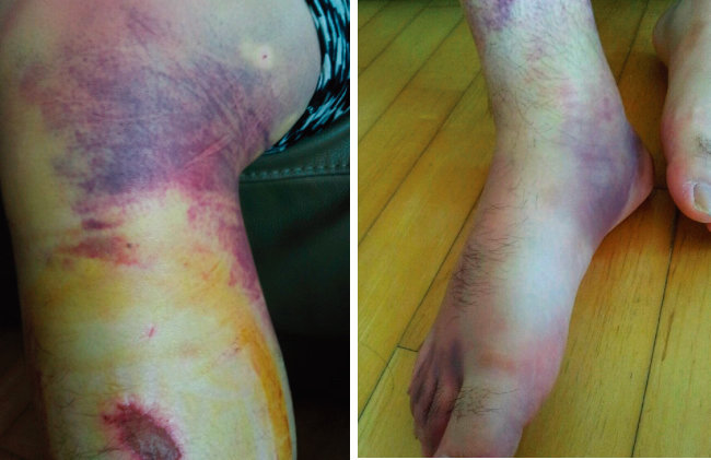 부산대병원에서 발생한 폭행 사건으로 전공의들의 다리와 발에 피멍이 든 모습.[뉴스1]