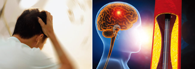 뇌졸중은 뇌혈관이 막혀 발생하는 뇌경색과 뇌혈관 파열로 뇌 조직 내부에 혈액이 유출되는 뇌출혈을 총칭하는 질환이다. [GettyImages]