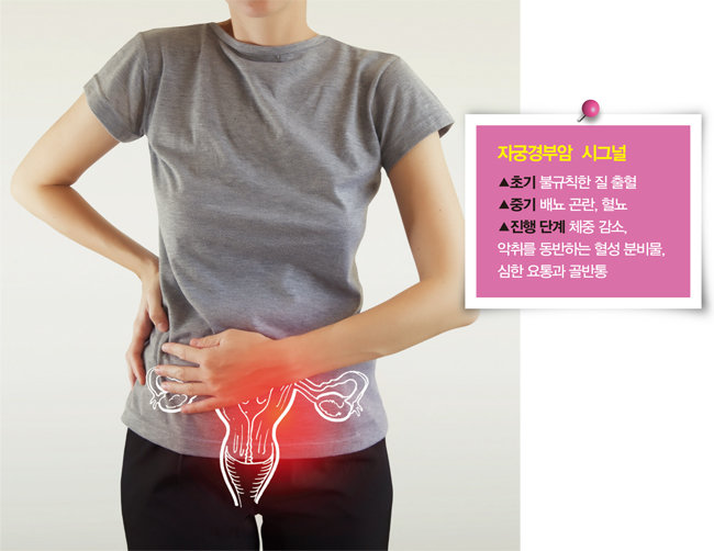 자궁 입구인 자궁경부에 발생하는 자궁경부암은 전 세계적으로 여성에게서 흔하게 발병한다. [GETTYIMAGES]