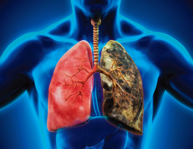 폐는 손상되면 직접적으로 치료가 되지 않기 때문에 금연과 운동을 생활화해야 한다. [GETTYIMAGES]