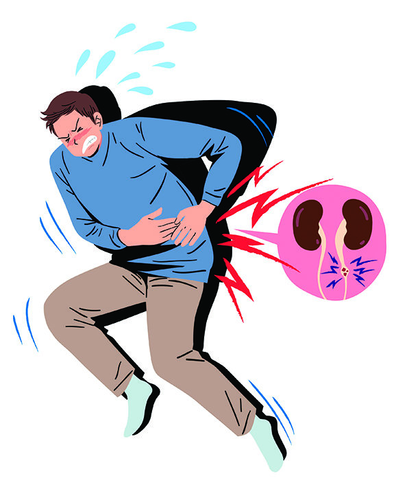 신장결석은 체내 칼슘옥살레이트(옥살산칼슘) 생성과 관계가 있다. GETTYIMAGES