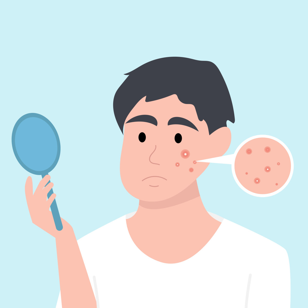 여드름이 나는 원인 가운데 혐기성 세균(여드름균)이나 두꺼운 각질층과 관련된 것은 생활 습관 개선으로 해결될 여지가 있다. GETTYIMGAES