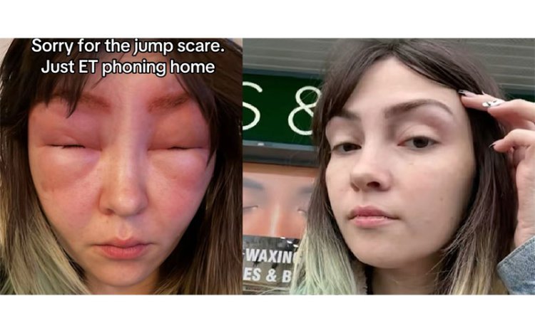 “눈썹 염색하다 ‘외계인’ 됐다”…알레르기 테스트의 중요성