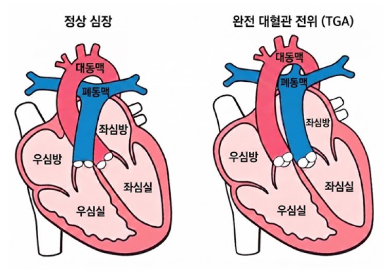 “완전 대혈관 전위 환자 수술후 30년 생존율 90%”
