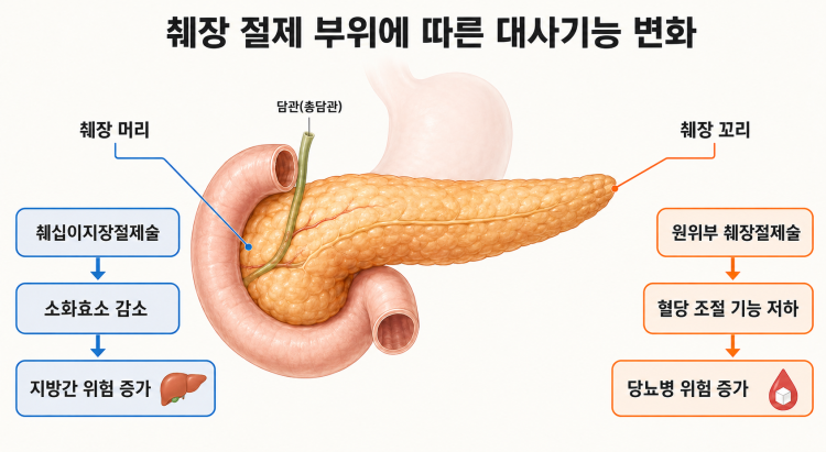 췌장 수술 후 혈당·지방간 위험…해법은 ‘덜 자르고 효소 보충’