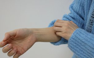 “지긋지긋 두드러기”…먹는 표적치료제 국내 도입 추진