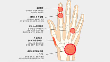 27개 뼈로 이뤄진 손…통증 부위별 의심되는 관절 질환은?