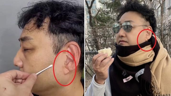쓰러진 김수용 전조증상 포착? …귓볼에 ‘이것’ 있었다