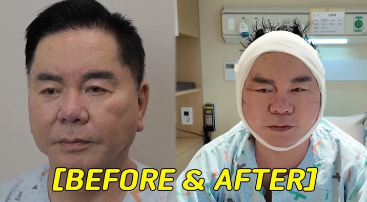 심형래, 안면거상술 받았다…“얼굴 리모델링 해 유튜브”