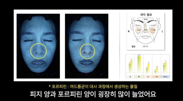 설탕·밀가루만 먹었더니…피부과 의사 피부 나이 5년 늙었다